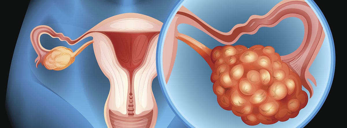cancer-de-ovario Cáncer de ovario: imagen representando el cáncer de ovario